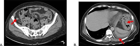Abdominal tomography: (A) Thickened cecal appendix and (B) Perisplenic free fluid, splenic flexure of the colon with exophytic tumor.