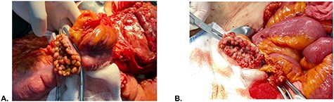 Intraoperative findings. (A) Colonic mucosa and (B) rectal stump mucosa.