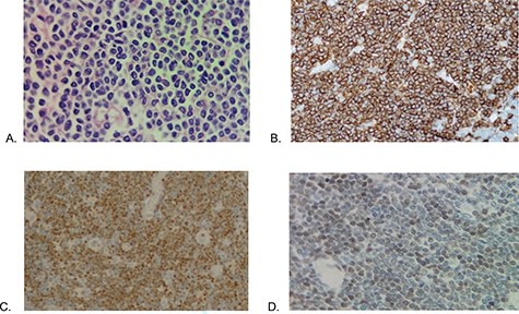 Histopathology (A) Proliferation of atypical lymphoid cells in colonic mucosa and submucosa (hematoxylin eosin—×100), (B) CD20 positive, (C) cyclin D1 positive and (D) SOX11 positive.