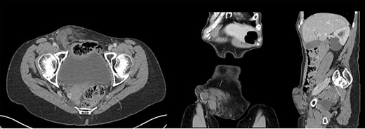 CT scan images of a 68-year-old woman who presented with acutely inflamed appendix within a right inguinal hernia sac (Amyand’s hernia) during COVID-10 pandemic.