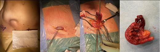 Intraoperative pictures of a 68-year-old woman who presented with acutely inflamed appendix within a right inguinal hernia sac (Amyand’s hernia) during COVID-10 pandemic: (A) Preoperative examination finding of right-sided incarcerated inguinal hernia. (B, C) Strangulated acute appendicitis. (D) Surgical specimen post-appendectomy.