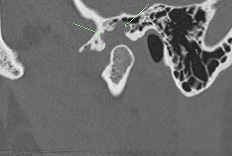 Non-contrast CT TMJs. Sagittal view showing the left TMJ erosive lesion within the glenoid fossa and articular eminence (green arrow).