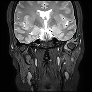 Post-gadolinium T2 MRI TMJs. Coronal view showing marked distension of the superior joint compartment with extensive scalloped lobulated erosion of the left temporal bone (green arrow).