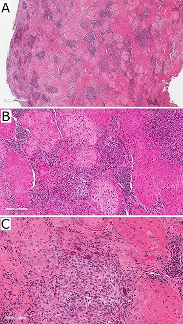 Photographs of haematoxylin and eosin-stained slides of the resected tissue sample showing fibrohistioctyic areas in addition to cartilaginous nodules. Magnification (A) ×94, (B) ×375, (C) ×750.