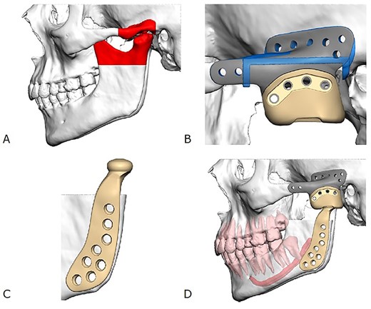 Illustration of the custom TMJ prosthesis. (A) Area planned for resection (red), (B) titanium zygomatic fossa component (grey) fixated to an UHMWPE fossa component (yellow), (C) titanium alloy mandibular component and (D) final relationship of all three components comprising the custom TMJ prosthesis.