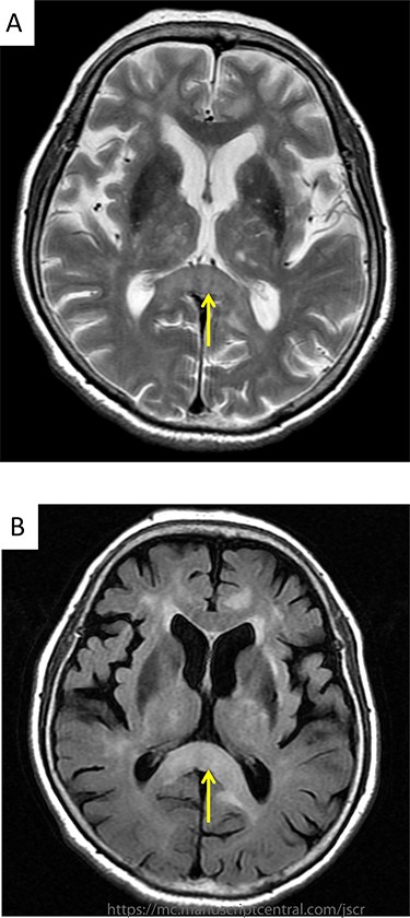 (A) Brain MRI revealed hyperintensity signals on T2-weighted image at the splenium of the corpus callosum; (B) brain MRI revealed hyperintensity signals on FLAIR images at the same region.