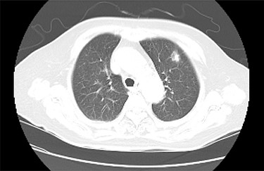 Chest CT detected a nodule with an irregular margin measuring 17 × 14 mm in size at the subpleural area of the left upper lobe S3 of the lung.