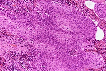 Histopathologic slide shows keratin pearls of squamous cell carcinoma (hematoxylin and eosin stain, 200× magnification).