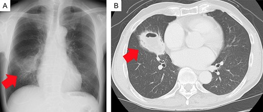 Imaging findings. (A) Chest radiograph showing an abnormal shadow in the right-middle lung field (red arrow). (B) Chest computed tomography scan showing a tumor with a cavity, ~55 mm in diameter, in the right-middle lobe (red arrow).