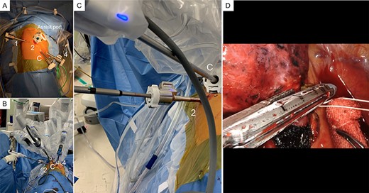 Robotic-assisted thoracoscopic surgery (RATS) findings. (A) A 4-cm utility thoracotomy performed at the fourth intercostal space (ICS) in the middle axillary line. Two 8-mm robotic trocars are inserted in the eighth ICS at the middle axillary line as a port for the robotic camera and the posterior side of the tip of the scapula as port 1, respectively. Two 12-mm robotic trocars were inserted in the seventh ICS anteriorly along the anterior axillary line as port 4 and in the seventh ICS along the posterior axillary line as port 2. The line marked as ‘1’ indicates port 1; ‘2’, port 2; ‘C’, the camera port; and ‘4’, port 4. (B, C) An assistant using a narrow-type vascular stapler (Signia small-diameter reload, Covidien Japan, Tokyo, Japan) through an 8-mm port with port 2. The pulmonary vein was divided using the narrow-type vascular stapler. (D) The pulmonary vessels were divided using the narrow-profile vascular stapler (Signia small-diameter reload) through the 8-mm port.