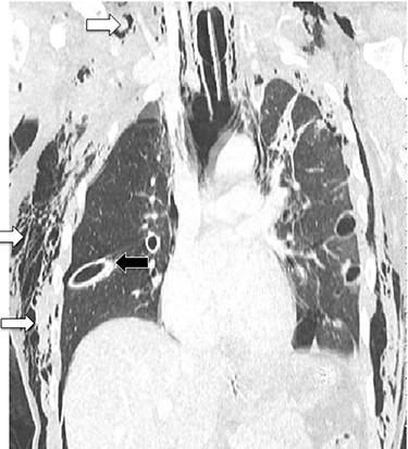 CT chest showing chest tubes in situ (black arrow) and soft tissue emphysema (white arrows).