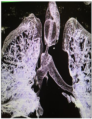 Reconstructed CT scan showing injury site of trachea.