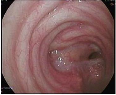 Flexible bronchoscopy showing tight tracheal narrowing.