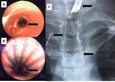 (A) Rigid bronchoscopy show 4 mm stenosis of the distal trachea, (B) intra-tracheal showing the stent following dilatation and placement of stent, (C) plain X-ray showing stent in place, feeding tube and endotracheal tube.