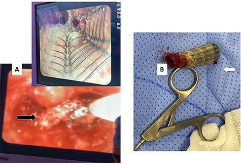 (A) Rigid bronchoscopy revealed the lower end of the stent to be embedded in granulation tissue. (B) The stent after removal showing the distal part with granulation tissue.