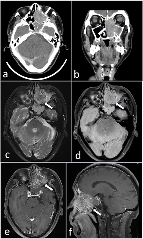 (a and b) CT revealed a tumor 5.5 cm in size in the left nasal cavity (arrow). (c–f) Magnetic resonance imaging revealed a tumor 5.5 × 4 × 3 cm in size occupying the left ethmoidal sinus and left nasal cavity, with invasion of the left orbital cavity, left maxillary sinus and intracranial cavity (arrow).