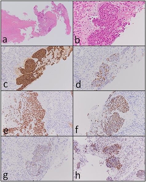 Histopathological and immunohistochemical findings of the paranasal sinus tumor. (a and b) Atypical cells with eosinophilic cytoplasm proliferating in a solid nest pattern and displaying massive necrosis were observed (hematoxylin and eosin staining, ×40 and ×400). The tumor cells were positive for (c) cytokeratin AE1/AE3 (×200), (d) p63 (×200), (e) Sox-2 (×200), (f) SALL4 (×200), (g) CDX-2 (×200) and (h) p53 (×200).