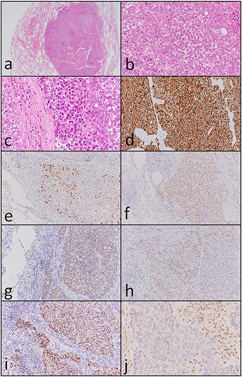 Histopathological and immunohistochemical findings of the lung tumor. (a and b) Atypical cells with clear-to-slightly eosinophilic cytoplasm proliferating in a solid nest pattern and displaying comedo necrosis (hematoxylin and eosin staining, ×40 and ×400). (c) Some of the atypical cells showed a ‘rhabdoid’ morphology such as eccentric nuclei (hematoxylin and eosin staining, ×400). Tumor cells were positive for (d) cytokeratin AE1/AE3 (×200), (e) p63 (×200), (f) Sox-2 (×200), (g) SALL4 (×200), (h) CDX-2 (×200) and (i) p53 (×200). (j) SMARCB1 expression was completely absent in the nuclei of the tumor cells but was observed in the nuclei of surrounding non-neoplastic cells (×400).