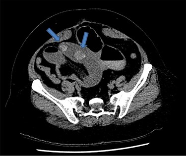 Axial CT image demonstrates two 25-mm gallstones (blue arrows) in a loop of small bowel in the right lower quadrant.
