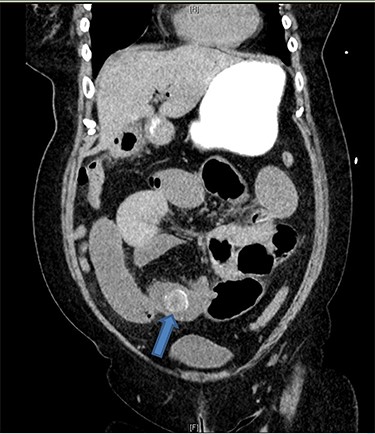 Coronal CT image demonstrates gallstones (blue arrow) (only one gallstone shown on this image) in a loop of small bowel in the right lower quadrant.