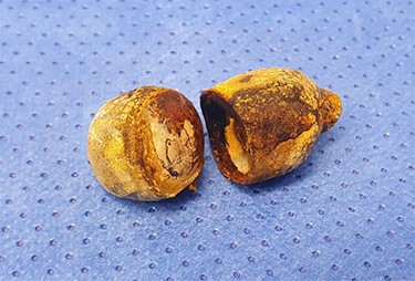 Two gallstones were delivered via enterolithotomy.