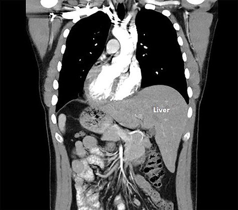 Coronal cross-section image of computed tomography scan.