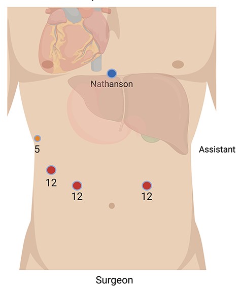 Abdominal port placement