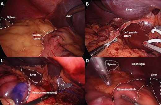 Series of intra-operative images: (A) major abdominal structures noted on opposite sides, in keeping with situs inversus totalis, (B) left gastric artery demonstrated coursing to the patient’s right side, (C) transected pylorus course from the patient’s right side, (D) alimentary limb shown after completion of oesophago-jejunal anastomosis.