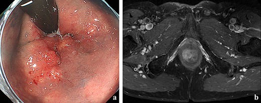 (a) Colonoscopy showed erythema of the mucous membrane from the anal canal to the rectum; (b) MRI showed that the levator ani muscle was ruptured by the tumor.