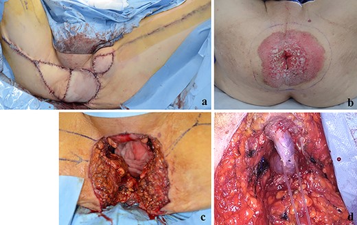 (a) The perineal defect was reconstructed using the gracilis muscle flap; (b, c) PS lesion was excised with a margin of 1 cm or more; (d) the bulbar urethra was exposed from the perineum.