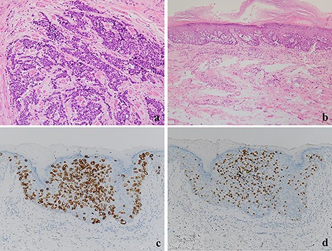 (a) The tumor cells with a high nuclear cytoplasmic ratio nuclei proliferated with compact nests in the anal canal (×100); (b) the tumor cells did not show neuroendocrine differentiation and were only components of tubular adenocarcinoma in the perianal lesions (×200); (c, d) The tumor cells were positive for CK20 and CDX2, respectively (×100).