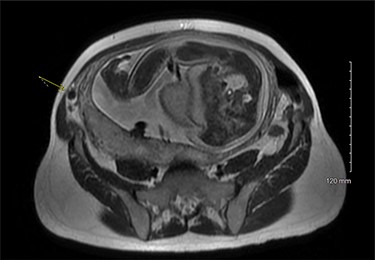 MRI pelvis, axial view.