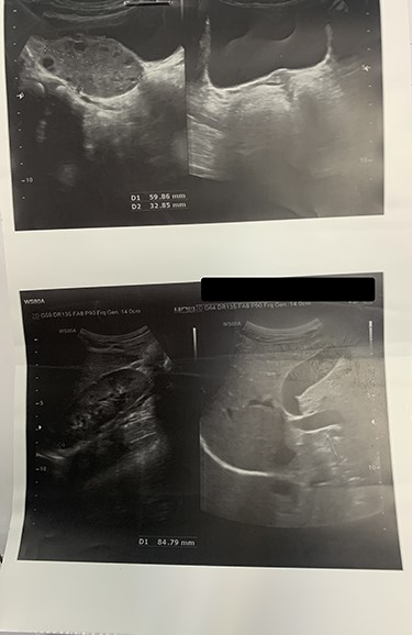 Ultrasonography shows the enlargement of the right ovary in size of 59 × 32 mm with increased stroma vulnerable of ovarian torsion. Uterus and the left ovary cannot be seen.