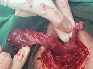 Findings of laparotomy: Torsion of right ovary and hypoplasia of the left adnexa. Uterus cannot be seen. Note the long ligament of the right ovary.