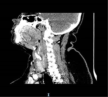 CT scan showing location of fish bone.