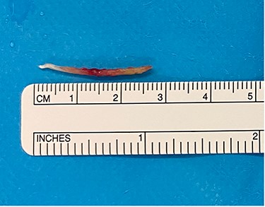 Fishbone after surgical retrieval.