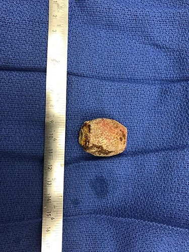Patient 1 gallstone.