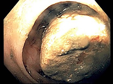 Image of gallstone from Patient 1 colonoscopy.
