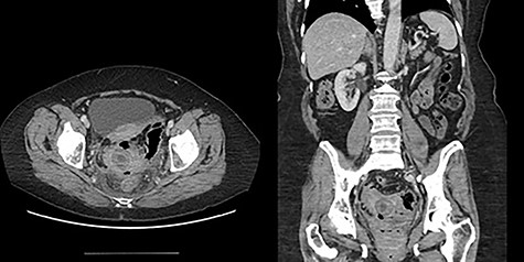 Patient 2 representative CT scan cuts.