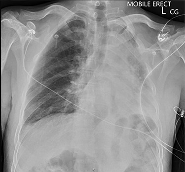 Chest X-ray illustrating complete collapse of the left lung lobe.