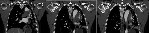 Contained thoracic aneurysm rupture.