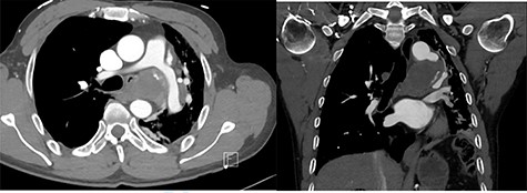 Rupture thoracic aneurysm compressing the left main bronchus.