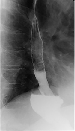 Barium swallow showing hiatal hernia postendoscopic gastroplasty.