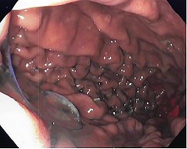 Intraoperative endoscopy showing loose gastroplasty sutures along the greater curvature of the stomach.