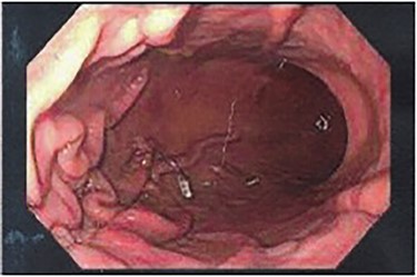 Preoperative endoscopy (post gastroplasty) showing the body of the stomach without restrictive sleeve appearance.