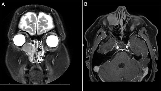 MRI demonstrating (A) coronal T2 demonstrating a homogenous, markedly hyperintense lesion of the right medial orbit, extending into the lacrimal duct. The contrast enhanced axial T1-weighted imaging demonstrates homogenous enhancement of the lesion with contrast.