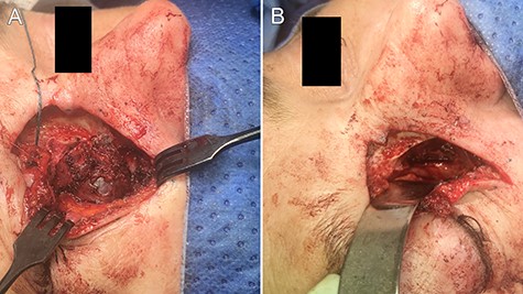 intraoperative images demonstrating (A) exposure of the lesion and (B) the post-excisional cavity.