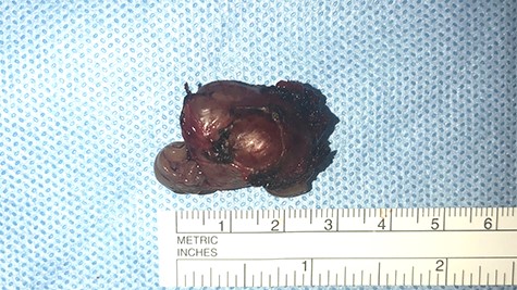 macroscopic image of the lesion demonstrating a 3 × 2 cm well-circumscribed, irregular soft tissue mass.