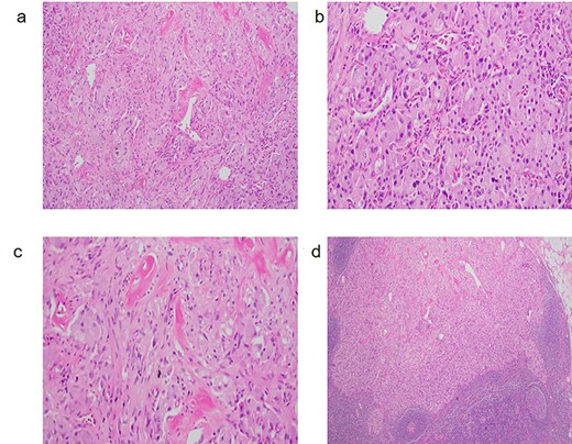 (a) GP with characteristic triphasic pattern: epithelioid endocrine-like cells admixed with an area of spindle Schwann-like cells and scattered ganglion type cells. (b) The epithelioid endocrine-like cells are arranged in compact nests reminiscent of carcinoid tumor or paraganglioma; (c) spindle Schwann-like cells are arranged haphazardly in a loose fascicular pattern. (d) GP tumor deposit, which metastasized to a regional lymph node.