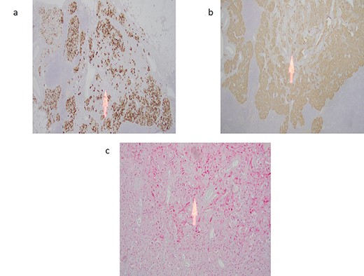 (a) Cytokeratin immunostain highlights the epithelioid endocrine-like cells with sparing of the spindle cell areas (arrow). (b) Synpatophysin immunostain illustrating cytoplasmic positivity in the epithelioid endocrine-like cells with absent staining in the spindle cell areas (arrow). (c) S100 immunostain highlights the spindle Schwann-like cells only (arrow) with negative staining in the epithelioid endocrine-like areas.